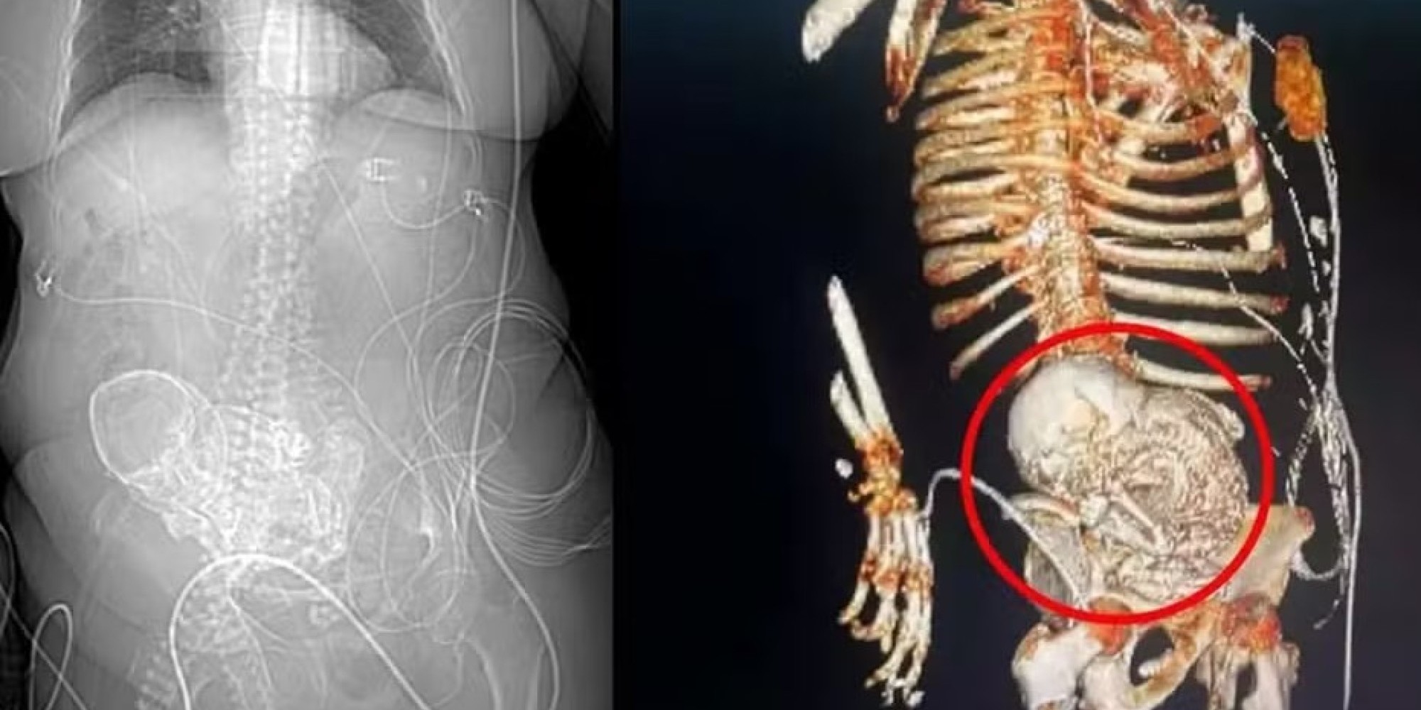 “Bebê de pedra”: Idosa descobre feto calcificado que carregou por 56 anos